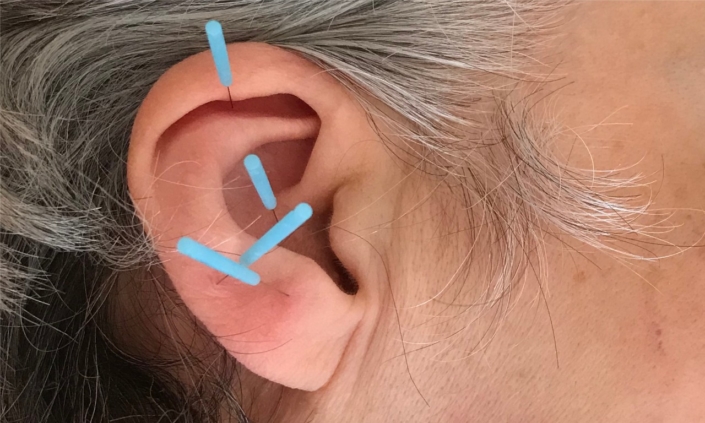 Ohrakupunktur Ohrakupunktur